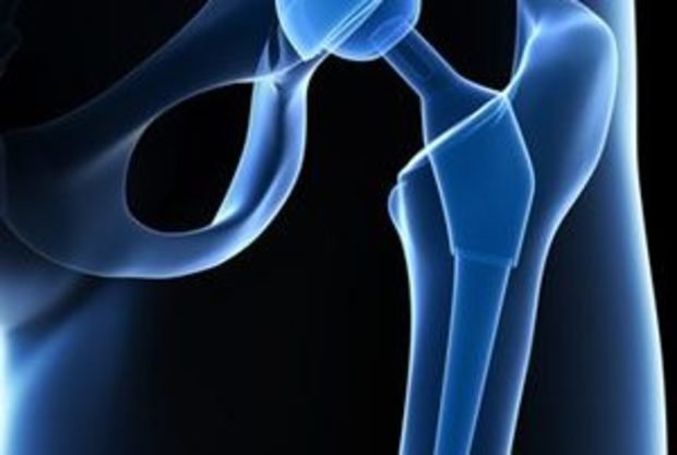 Hip Replacement Devices Market 2023