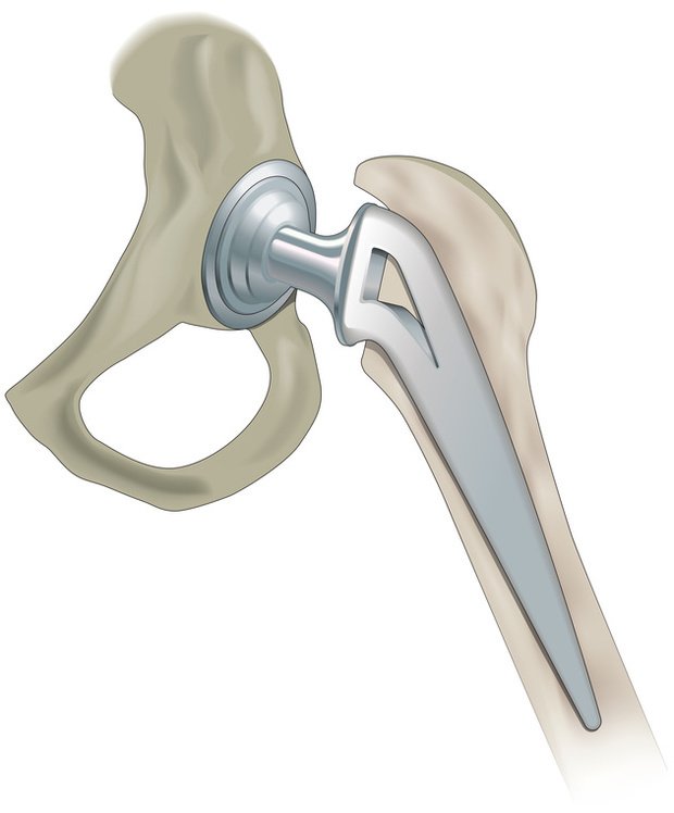 Europe Hip Replacement Devices Market